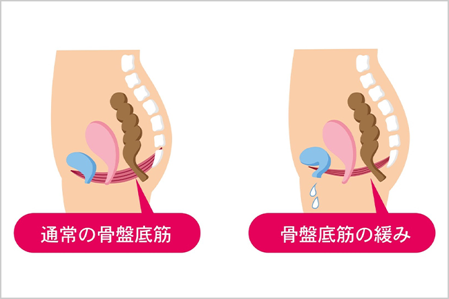 尿漏れの原因のイメージ画像