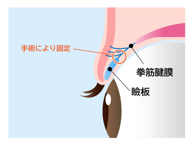 つかもと形成外科・創傷クリニックでの眼瞼下垂手術眼瞼挙筋前転法