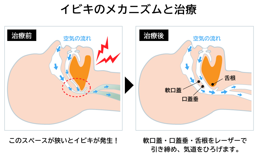 神戸市垂水区のつかもと形成外科・創傷クリニック いびきのメカニズム