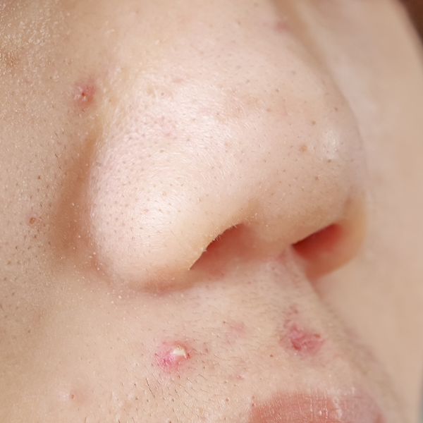 ニキビ跡の赤み
