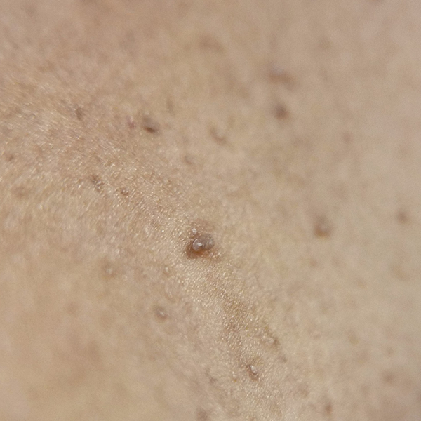 首イボ取り治療